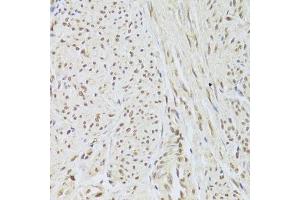 Immunohistochemistry of paraffin-embedded human adenomyosis using SNRPA Antibody. (SNRPA1 antibody  (AA 1-282))