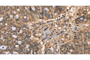 Immunohistochemistry of paraffin-embedded Human ovarian cancer tissue using HK3 Polyclonal Antibody at dilution 1:40 (HK3 antibody)