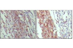 Immunohistochemical analysis of paraffin-embedded human lymph node tissue,showing membrane and cytoplasmic localization with DAB staining using CD45 antibody. (CD45 antibody)