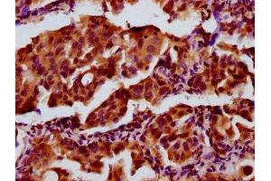 IHC image of ABIN7143405 diluted at 1:300 and staining in paraffin-embedded human lung cancer performed on a Leica BondTM system. (AEBP1 antibody  (AA 46-234))