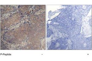 Imunohistochemical analysis of paraffin-embedded human breast carcinoma tissue, using MYL2 (phospho S19) polyclonal antibody . (MYL12A antibody  (pSer18))