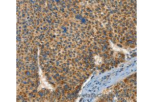 Immunohistochemistry of Human breast cancer using IFT74 Polyclonal Antibody at dilution of 1:60 (IFT74 antibody)