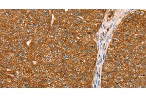 Immunohistochemistry of paraffin-embedded Human breast cancer tissue using ABCC8 Polyclonal Antibody at dilution 1:40 (ABCC8 antibody)