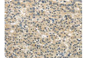The image on the left is immunohistochemistry of paraffin-embedded Human liver cancer tissue using ABIN7193043(WDR91 Antibody) at dilution 1/20, on the right is treated with synthetic peptide. (WDR91 antibody)