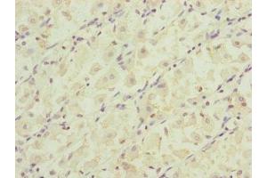 Immunohistochemistry of paraffin-embedded human gastric cancer using ABIN7164323 at dilution of 1:100 (RARS2 antibody  (AA 17-340))