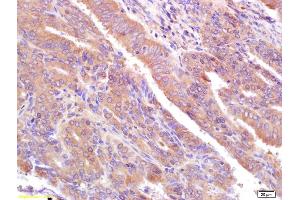 Formalin-fixed and paraffin embedded human breast cancer labeled with Rabbit Anti CA153/EMA/Mucin 1 Polyclonal Antibody, Unconjugated (ABIN673824) at 1:200 followed by conjugation to the secondary antibody and DAB staining (MUC1 antibody  (AA 1051-1255))
