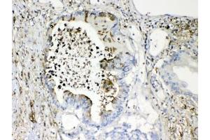 IHC testing of FFPE human intestinal cancer tissue with TMEM107 antibody at 1ug/ml. (TMEM107 antibody  (AA 22-57))