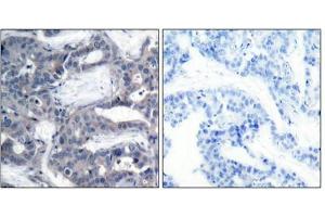 Immunohistochemical analysis of paraffin-embedded human breast carcinoma tissue using MEK-2(Phospho-Thr394) Antibody(left) or the same antibody preincubated with blocking peptide(right). (MEK2 antibody  (pThr394))