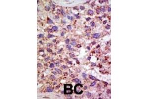 Formalin-fixed and paraffin-embedded human cancer tissue reacted with the primary antibody, which was peroxidase-conjugated to the secondary antibody, followed by AEC staining. (USP11 antibody  (N-Term))