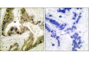 Immunohistochemistry analysis of paraffin-embedded human lung carcinoma tissue, using HDAC10 Antibody. (HDAC10 antibody  (AA 10-59))