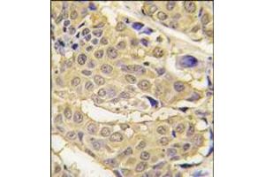 Formalin-fixed and paraffin-embedded human breast carcinoma tissue reacted with EPRS antibody (N-term), which was peroxidase-conjugated to the secondary antibody, followed by DAB staining.