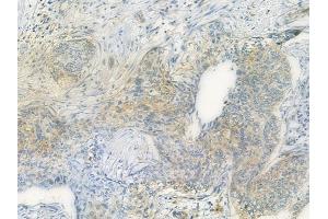 ABIN6259034 and ABIN6275060 at 1/100 staining human cervical carcinoma by IHC-P.