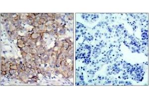 Immunohistochemistry analysis of paraffin-embedded human breast carcinoma, using HER2 (Phospho-Tyr877) Antibody.