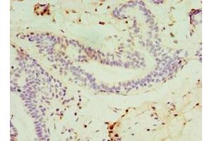 Immunohistochemistry of paraffin-embedded human breast cancer using ABIN7171169 at dilution of 1:100 (SYTL4 antibody  (AA 50-280))