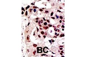 Formalin-fixed and paraffin-embedded human cancer tissue reacted with the primary antibody, which was peroxidase-conjugated to the secondary antibody, followed by DAB staining. (PIAS3 antibody  (AA 588-619))