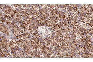 ABIN6279609 at 1/100 staining Human liver cancer tissue by IHC-P. (CHRNB3 antibody  (Internal Region))