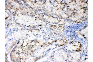 Hepatitis B Virus was detected in paraffin-embedded sections of human liver cancer tissues using rabbit anti- Hepatitis B Virus Antigen Affinity purified polyclonal antibody (Catalog # ) at 1 µg/mL. (HBV Large S Protein antibody  (N-Term))