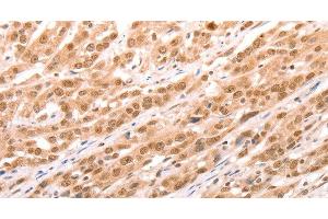 Immunohistochemistry of paraffin-embedded Human esophagus cancer tissue using TAX1BP1 Polyclonal Antibody at dilution 1:60 (TAX1BP1 antibody)