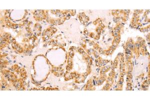 Immunohistochemistry of paraffin-embedded Human thyroid cancer using NAMPT Polyclonal Antibody at dilution of 1:30 (NAMPT antibody)