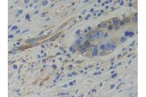 Detection of WARS in Human Prostate cancer Tissue using Polyclonal Antibody to Tryptophanyl tRNA Synthetase (WARS) (WARS antibody  (AA 247-458))