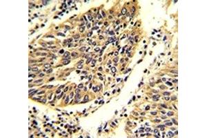 IHC analysis of FFPE human lung carcinoma stained with WNT4 antibody. (WNT4 antibody  (AA 242-269))