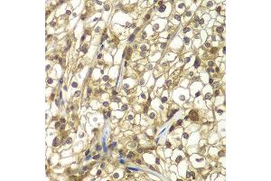 Immunohistochemistry of paraffin-embedded human kidney cancer using SULT2B1 antibody at dilution of 1:100 (x40 lens). (SULT2B1 antibody)