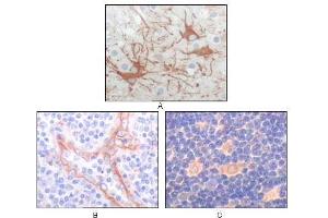 Immunohistochemical analysis of paraffin-embedded human cerebrum tumor (A), endothelium of vessel (B), lymphocyte of thymus(C), showing cytoplasmic localization using FES antibody with DAB staining. (FES antibody)