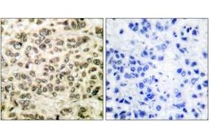 Immunohistochemistry analysis of paraffin-embedded human breast carcinoma tissue, using HDAC3 Antibody. (HDAC3 antibody  (AA 379-428))