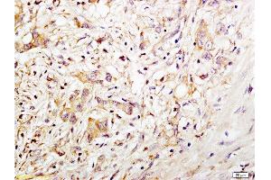 Formalin-fixed and paraffin embedded human gastric carcinoma tissue labeled with Anti-CD34 Polyclonal Antibody, Unconjugated at 1:200 followed by conjugation to the secondary antibody and DAB staining (CD34 antibody  (AA 201-300))