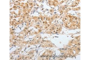 Immunohistochemistry of Human lung cancer using BPIFB2 Polyclonal Antibody at dilution of 1:45