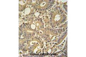 TPSD1 antibody (C-term) immunohistochemistry analysis in formalin fixed and paraffin embedded human colon carcinoma followed by peroxidase conjugation of the secondary antibody and DAB staining. (TPSD1 antibody  (C-Term))
