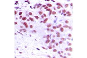Immunohistochemical analysis of MEOX2 staining in human breast cancer formalin fixed paraffin embedded tissue section. (MEOX2 antibody  (Center))