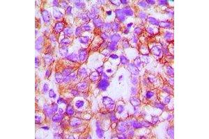 Immunohistochemical analysis of ABCB5 staining in human breast cancer formalin fixed paraffin embedded tissue section. (ABCB5 antibody)