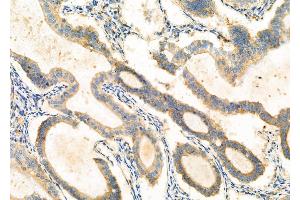 ABIN6262008 and ABIN6277066 at 1/100 staining human ovarian cancer by IHC-P.