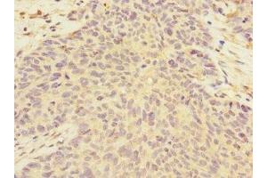 Immunohistochemistry of paraffin-embedded human ovarian cancer using ABIN7149955 at dilution of 1:100 (FMO2 antibody  (AA 210-470))