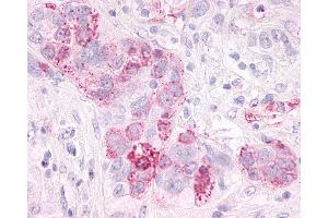 Anti-GPR3 antibody IHC of human Ovary, Carcinoma. (GPR3 antibody  (Extracellular Domain))
