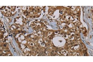 Immunohistochemistry of paraffin-embedded Human breast cancer tissue using PNN Polyclonal Antibody at dilution 1:50 (PNN antibody)