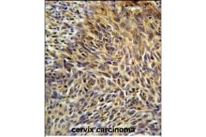 ANKRD32 Antibody (N-term) (ABIN651599 and ABIN2840316) immunohistochemistry analysis in formalin fixed and paraffin embedded human cervix carcinoma followed by peroxidase conjugation of the secondary antibody and DAB staining. (ANKRD32 antibody  (N-Term))