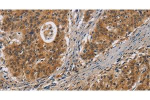 Immunohistochemistry of paraffin-embedded Human gastric cancer tissue using IL17D Polyclonal Antibody at dilution 1:50 (IL17D antibody)