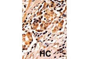 Formalin-fixed and paraffin-embedded human cancer tissue reacted with the primary antibody, which was peroxidase-conjugated to the secondary antibody, followed by AEC staining. (BAD antibody  (pSer75))