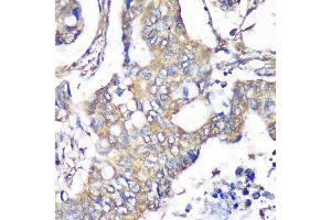 Immunohistochemistry of paraffin-embedded Human colon carcinoma using TXNDC9 Rabbit pAb  at dilution of 1:100 (40x lens). (TXNDC9 antibody  (AA 1-110))