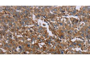Immunohistochemistry of paraffin-embedded Human liver cancer using GCK Polyclonal Antibody at dilution of 1:40 (GCK antibody)