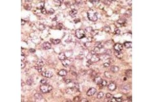 IHC analysis of FFPE human hepatocarcinoma tissue stained with the anti-ATG5 antibody (ATG5 antibody  (AA 209-238))