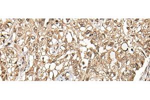 Immunohistochemistry of paraffin-embedded Human lung cancer tissue using CHFR Polyclonal Antibody at dilution of 1:35(x200) (CHFR antibody)