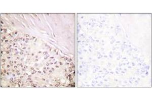 Immunohistochemistry analysis of paraffin-embedded human breast carcinoma tissue, using FANCD2 (Ab-222) Antibody. (FANCD2 antibody  (AA 188-237))