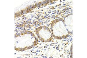 Immunohistochemistry of paraffin-embedded human gastric cancer using KISS1R Antibody (ABIN5971525) at dilution of 1/200 (40x lens). (KISS1R antibody)