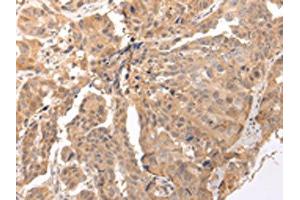 The image on the left is immunohistochemistry of paraffin-embedded Human breast cancer tissue using ABIN7190290(CLDND2 Antibody) at dilution 1/45, on the right is treated with synthetic peptide.