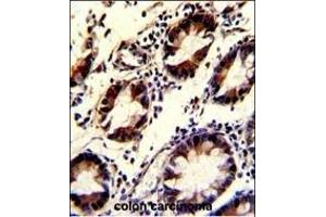 Formalin-fixed and paraffin-embedded human colon carcinoma with KLF4 Antibody, which was peroxidase-conjugated to the secondary antibody, followed by DAB staining. (KLF4 antibody)