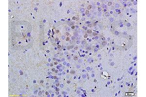 Formalin-fixed and paraffin embedded human colorectal cancer labeled with Anti OCT4B-190 Polyclonal Antibody, Unconjugated (ABIN704531) at 1:200 followed by conjugation to the secondary antibody and DAB staining (Oct-4BOCT4B-190NT (AA 201-300) antibody)