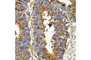 Immunohistochemistry of paraffin-embedded human colon carcinoma using QARS antibody.